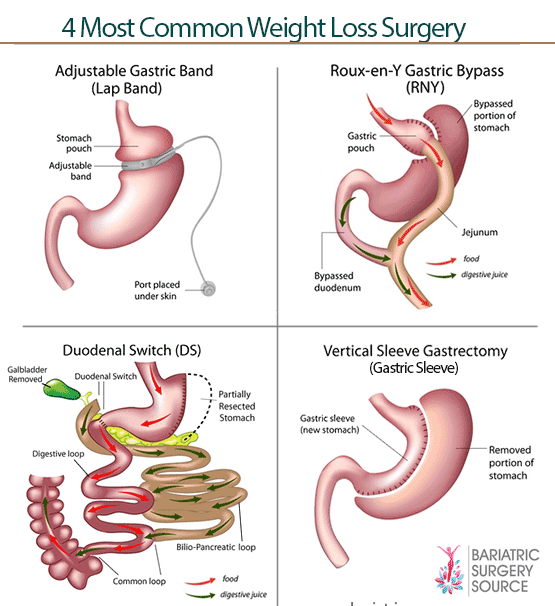 Best Laparoscopic Mini Gastric Bypass Surgery in Mumbai, India