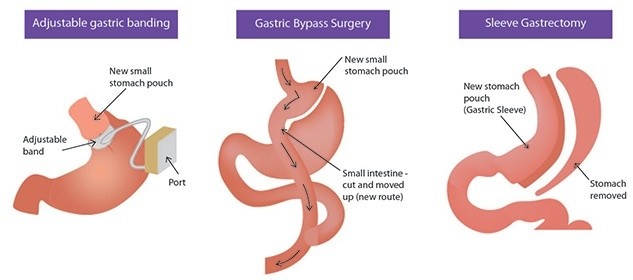 Best Bariatric Surgery - Obesity & Weight Loss Surgery in Mumbai, India